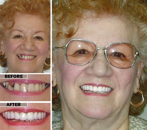 Dental Implants vs. Dentures - Brooklyn Implant Dentist