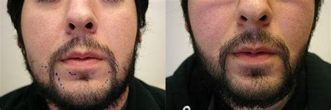 Facial Hair Restoration Patient 1 | Limmer Hair Transplant Center