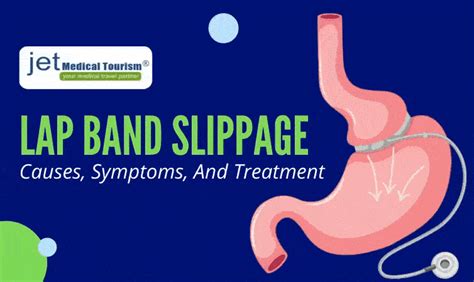 Lap Band Slippage: Causes, Symptoms, And Treatment