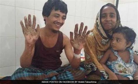 Bangladesh 'Tree Man' Sees Hope After 16 Surgeries