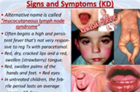 Mucocutaneous Lymph Node Syndrome