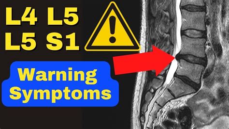 Symptoms Of Severe Spinal Stenosis Of L4-L5 Premia Spine, 41% OFF