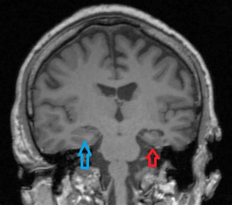 Hippocampal sclerosis causes, symptoms, diagnosis & treatment