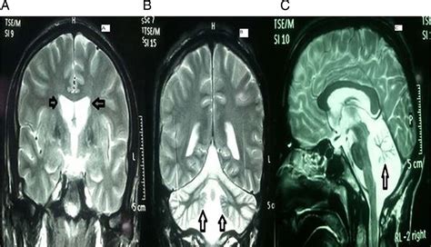 Cerebellar atrophy in neuroacanthocytosis | BMJ Case Reports