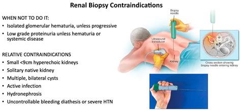 Renal Biopsy Needle