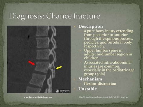 Chance Fracture