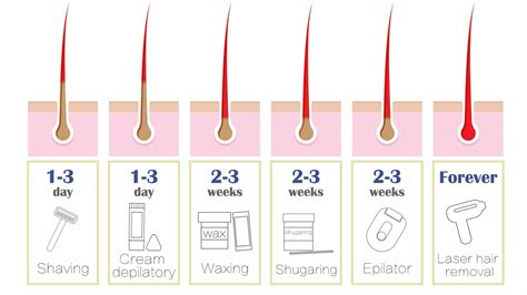 Epilation vs Laser Hair Removal - London Premier Laser & Skin Clinic