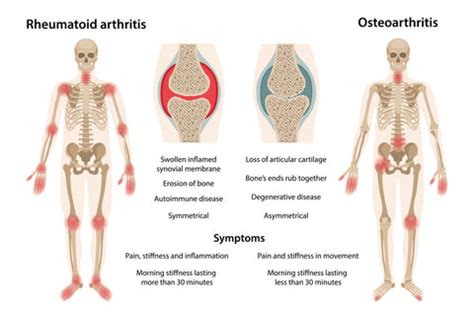 What is the difference between Osteoarthritis and Rheumatoid Arthritis – Mountain Ice Pain ...