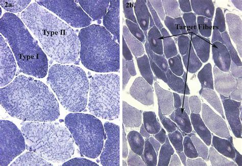 NADH showing Type I (dark) and Type II (light) myofibers. (a) Normal ...