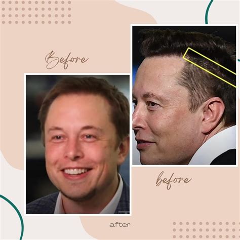 Elon Musk Hair Transplant: What You Should Know About The Procedure