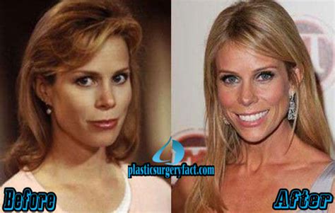 Cheryl Hines Plastic Surgery Before After Defends