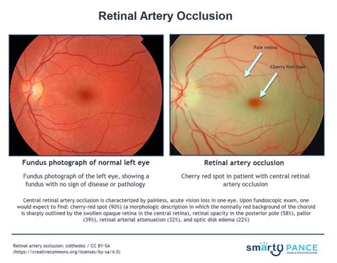 Cherry Red Macula Vs Normal Macula