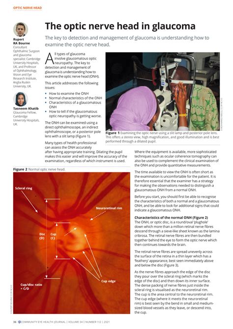 (PDF) The optic nerve head in glaucoma