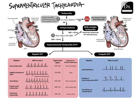 Supraventricular Tachycardia Svt Florida Cardiology | Images and Photos finder