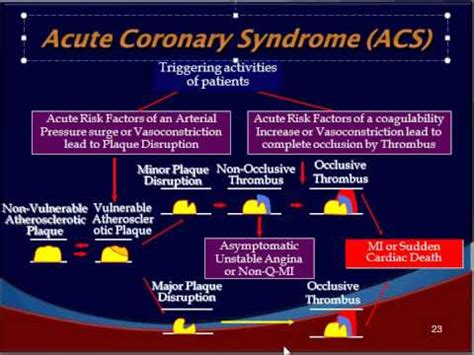 4 acute coronary syndrome pathogenesis - YouTube