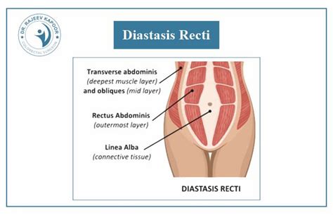 Divarication of Recti: Symptoms, Causes, and Treatment