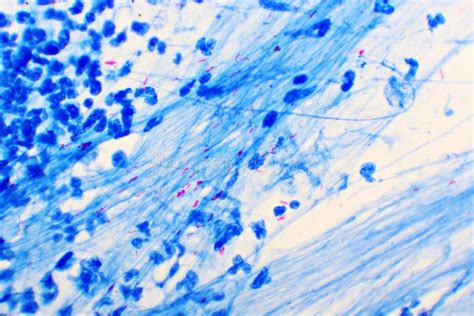 Mycobacterium Tuberculosis Positive in Sputum Smear Stock Photo - Image of cancer, laboratory ...