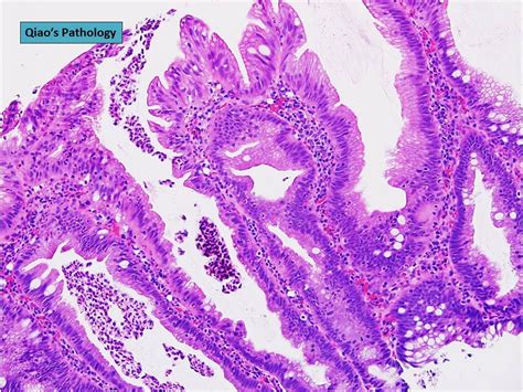 Qiao's Pathology: Sessile Serrated Adenoma of Right Colon - a photo on Flickriver