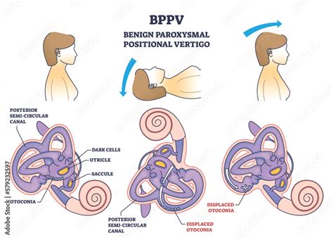 BPPV or benign paroxysmal positional vertigo syndrome outline diagram. Labeled educational ...