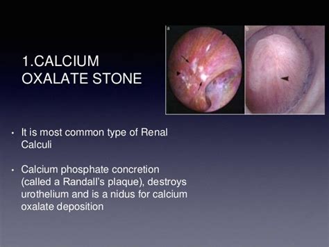 TYPES OF RENAL CALCULI