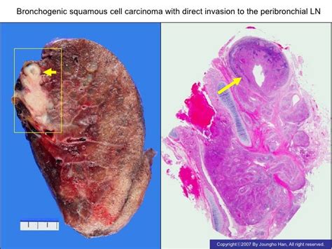 lung cancer squamous cell carcinoma