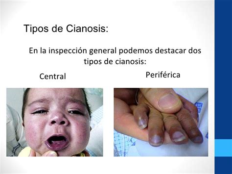 Cianosis