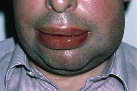 Upper Lip Swelling Food Allergy | Sitelip.org