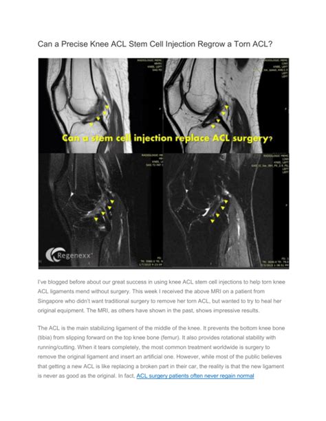 Can a Precise Knee ACL Stem Cell Injection Regrow a Torn ACL?