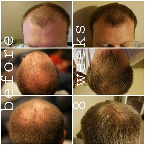 Monat stimulates follicles for regrowth of strong, healthy hair | Monat ...