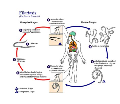 What is Filariasis? Causes, Symptoms, Treatment, & Prevention ...