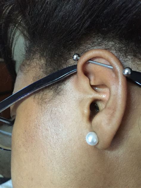 Keloid Ear