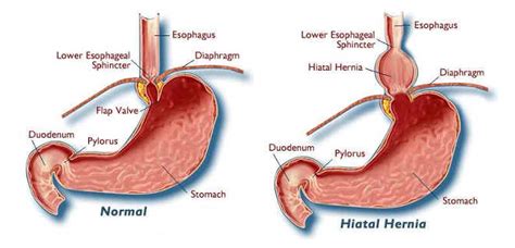 HERNIA DE HIATO O ENFERMEDAD POR REFLUJO - Instituto Quirúrgico de ...