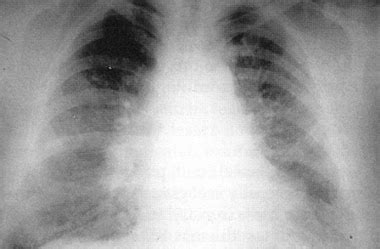 Chlorine Toxicity: Practice Essentials, Background, Pathophysiology