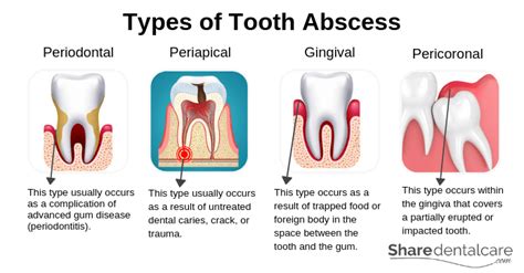 Tooth Abscess Pain