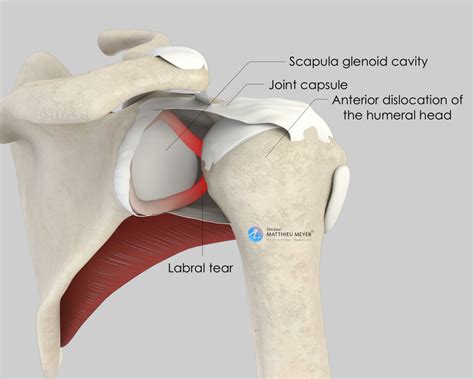 Coracoid Block (Latarjet Procedure) - Doctor Matthieu Meyer