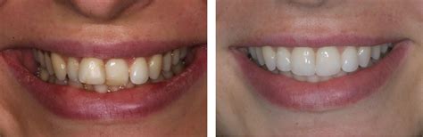 Inman Aligners Navan, Meath | Navan Dental