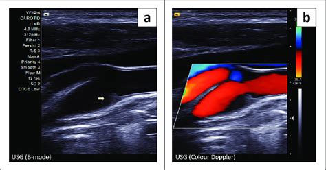 (a) Ultrasound of right carotid bulb in longitudinal section revealed a... | Download Scientific ...