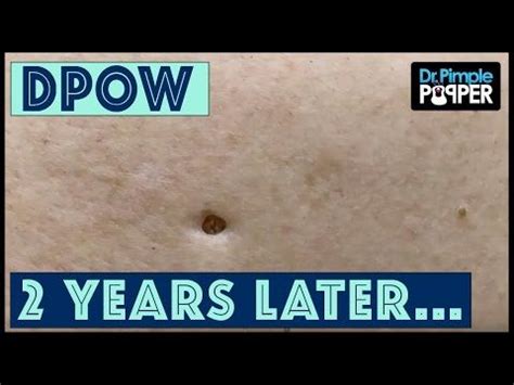 (1) Flip it & Reverse it Blackhead Extraction / Dilated Pore of Winer ...