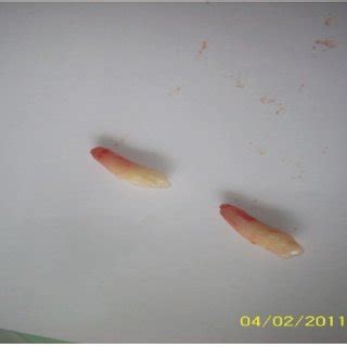 Post extraction: the extracted tuberculate supernumerary teeth. | Download Scientific Diagram