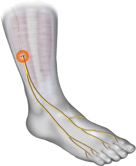 Peripheral nerve entrapments - Foot and Ankle Clinics