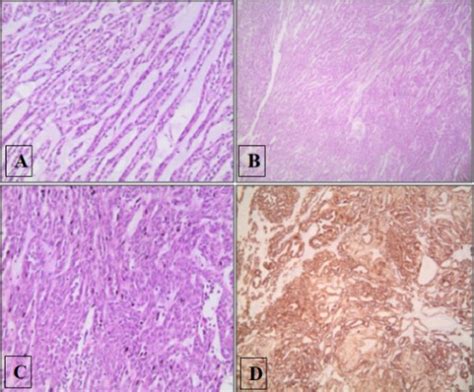 Mucinous Tubular Spindle Cell Carcinoma of the Kidney: Maybe the ...