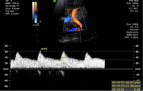 Uterine Artery Doppler Charts | My XXX Hot Girl