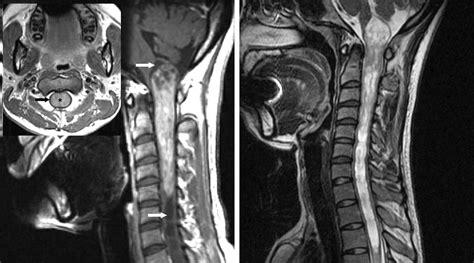 Intramedullary Spinal Cord Tumor | The Neurosurgical Atlas