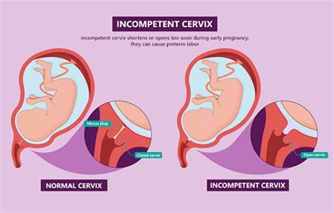 Cervical Cerclage Procedure