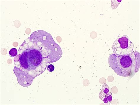 Reactive mesothelial cells with atypia. Mesothelial cells may contain ...