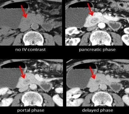 CT images: Annular pancreas | Download Scientific Diagram