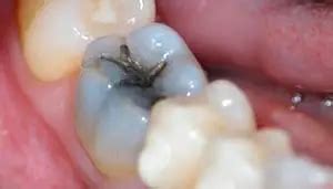 Infection in Gum after Root Canal: Causes and How to Avoid | IYTmed.com