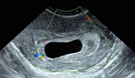 Does Hcg Continue to Rise With Blighted Ovum - Huff Hatrance