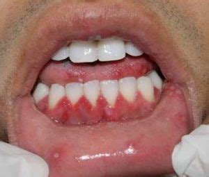 Herpetic gingivostomatitis (H. simplex) - Definition of Herpetic gingivostomatitis (H. simplex)