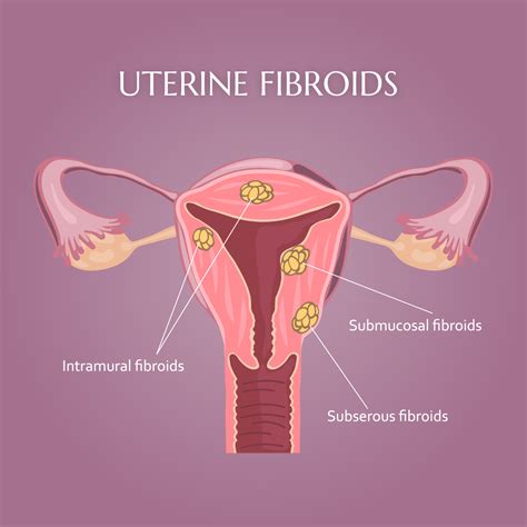 Fibroma Uterino O Mioma In Menopausa In Gravidanza Sintomi E Cause | Porn Sex Picture